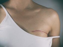 ožiljak rak dojke