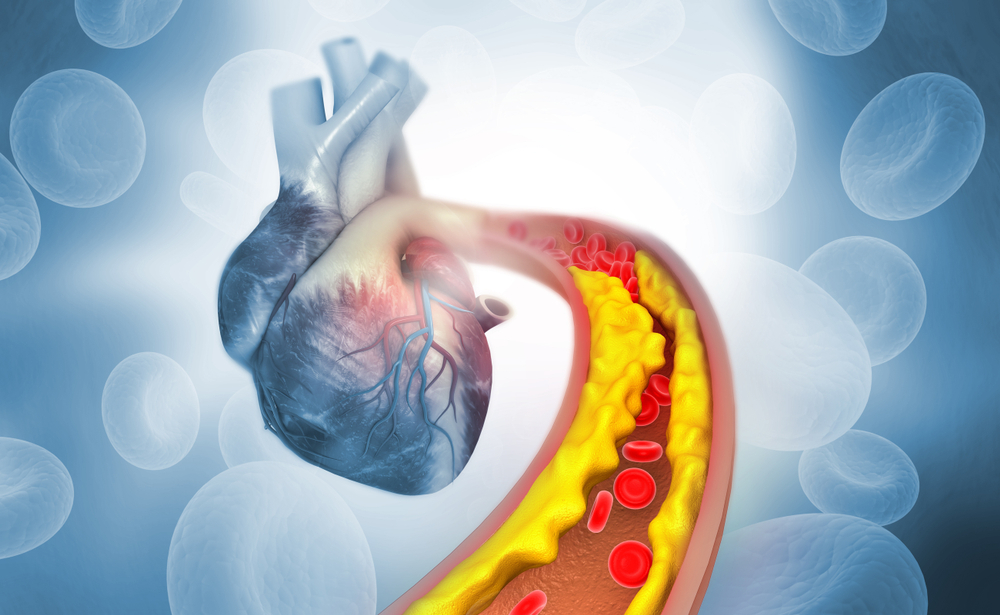 grafički prikaz holesterol koji ugrožava rad srca
