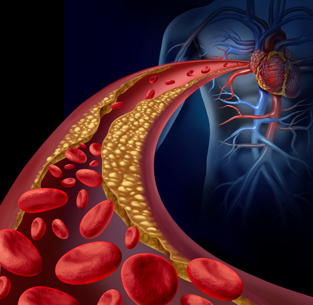 holesterol u krvnim sudovima