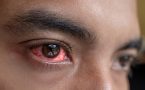 crveno oko-bolest-povreda
