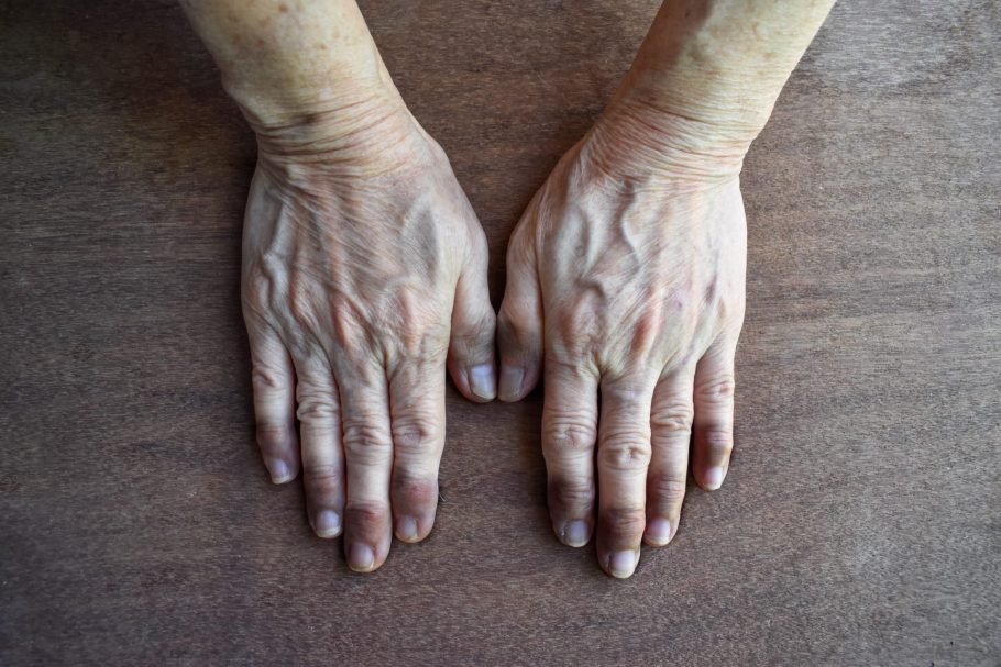cijanoza-plavi nokti-bolest