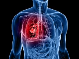 rak pluća- karcinom- plućna krila