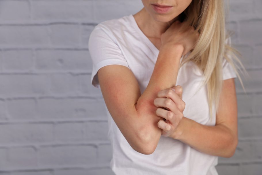 Osip se češće javlja na koži koja je osetljiva na sunčevu svetlost Foto: Shutterstock