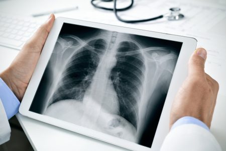pluća-covid19-rendgen