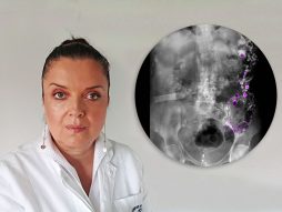 Dr Tatjana Radaljac, kolon, divertikulum, divertikuloza