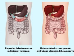 kolektomija-debelo crevo-tumor debelog creva