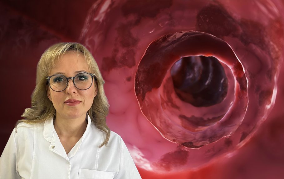 Prof.dr Tamara Milovanović, ulcerozni kolitis