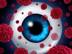 očni kancer- inakularni melanom -oči