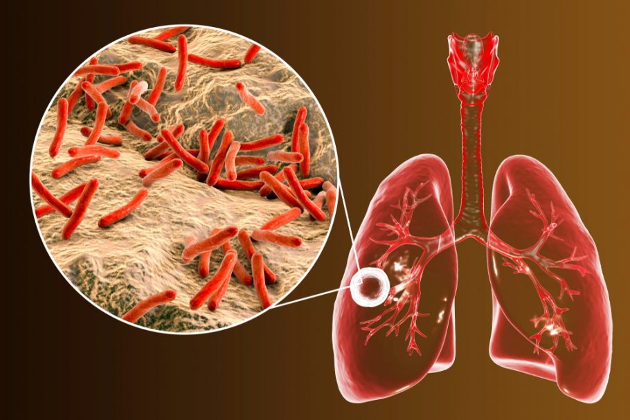 tuberkoloza-pluća-infekcija