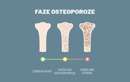 osteoporoza-kosti- zdravlje kostiju