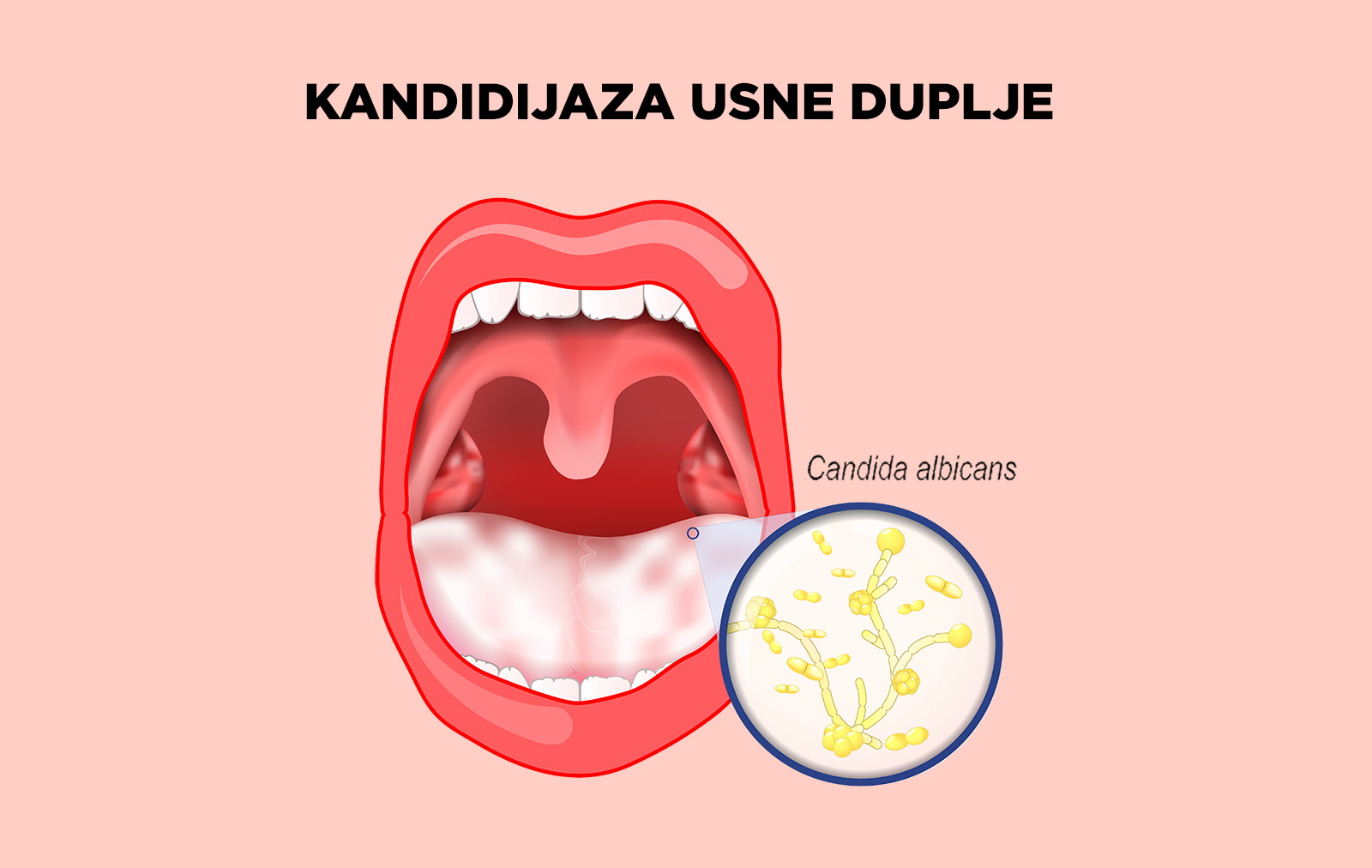Kandide kod usne oralni seks Kandijaza Lečenje