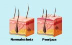 psorijaza- bolest kože- kardivaskularni problemi