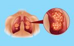 rak pluća- agresivan karcinom pluća- mikrocelularni rak