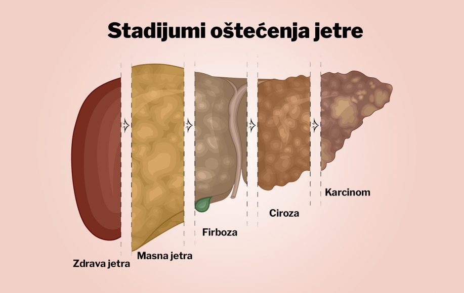 jetra-hronićne bolesti-rizik-masna jetra