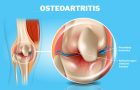 osteoartritis - zglob-hrskavica-ograničeni pokreti