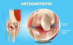 osteoartritis - zglob-hrskavica-ograničeni pokreti