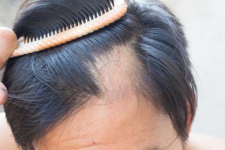 alopecija-gubitak kose- opadanje kose-pečati
