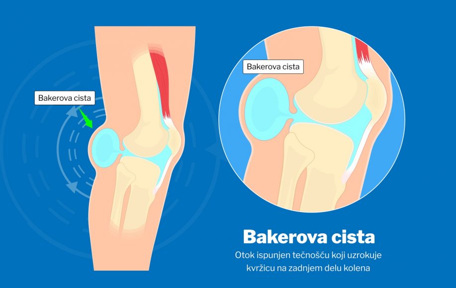 bakerova cista-cista na kolenu-pucanje ciste