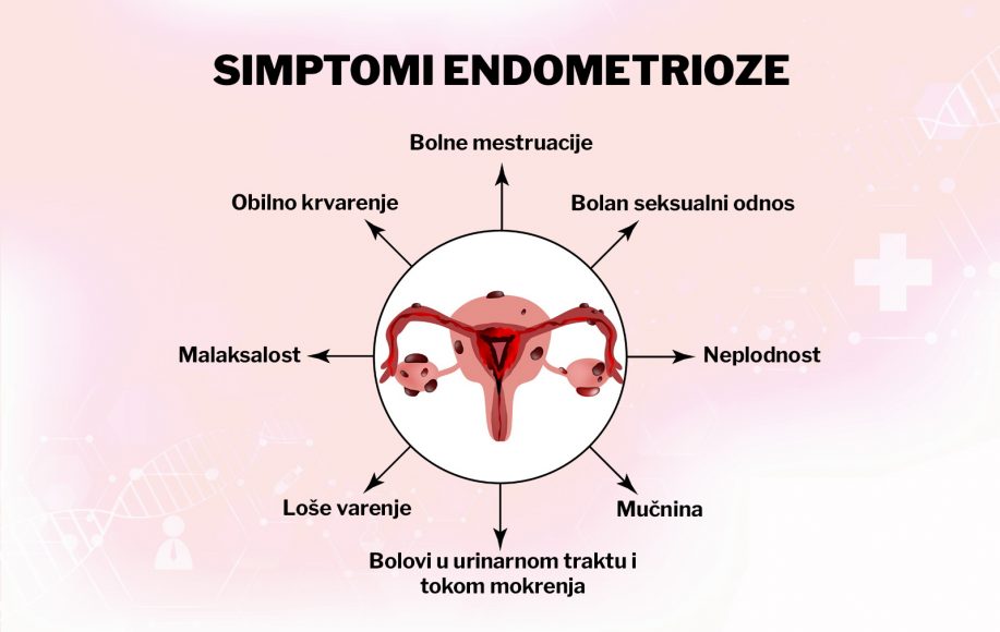 endometrioza- simptomi- lečenje