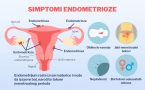 endometrioza. hormonski disbalans- bol u karlici- neplodnost