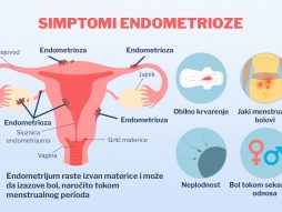 endometrioza. hormonski disbalans- bol u karlici- neplodnost