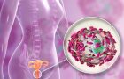 Bakterijska vaginoza- zdravljevagine- vaginalna mikrosredina
