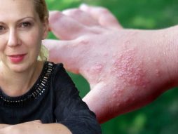 ekcem dishidroza- bolest kože- alergijska reakcija