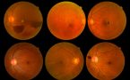 dijabetes- dijabetička retinopatija- skrinig oka