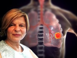Dr Ana Stojanović, pluća, pušenje, karcinom