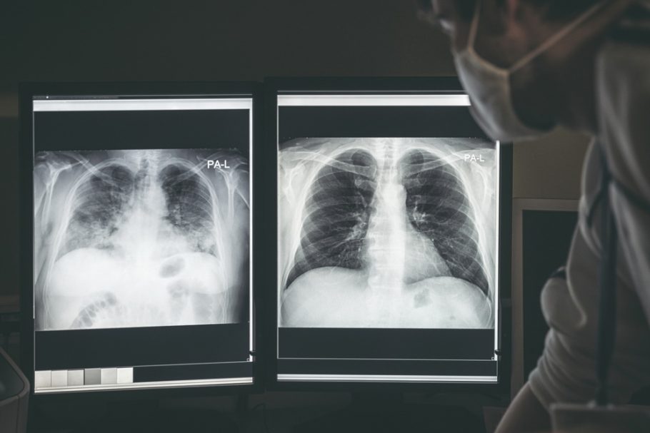 RTG pluća, covid 19,rentgen pluća