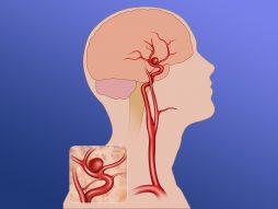 aneurizm mozga- proširenje krvih sudova- pucanje arterija