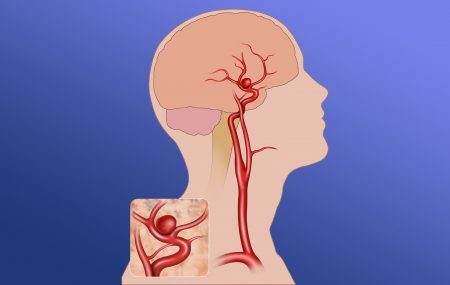 aneurizm mozga- proširenje krvih sudova- pucanje arterija