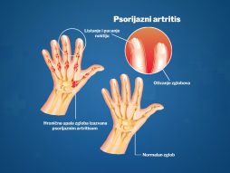 psorijazni artritis prstiju-psorijaza-lek