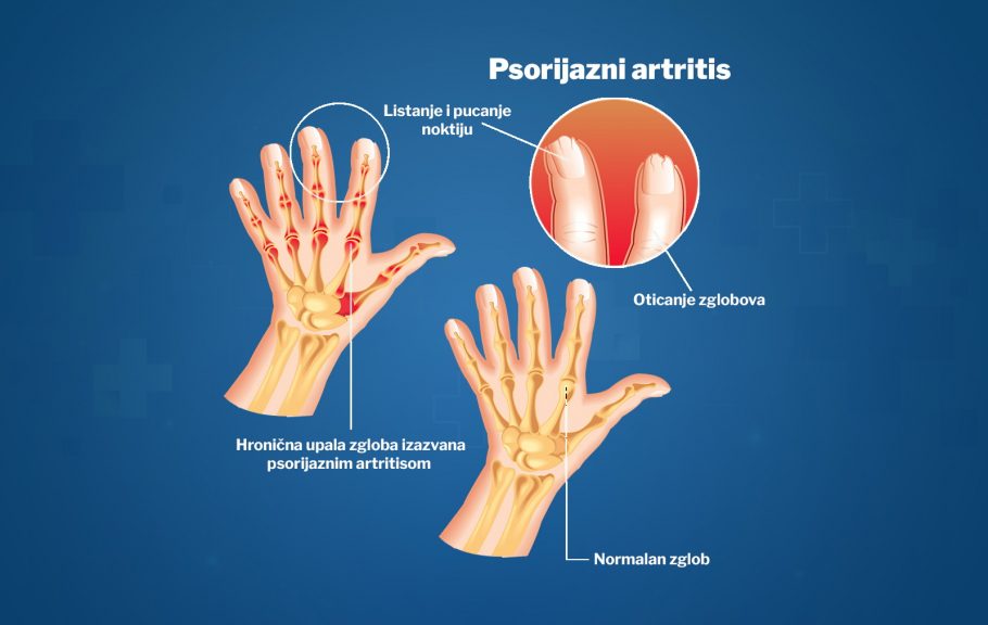 psorijazni artritis prstiju-psorijaza-lek