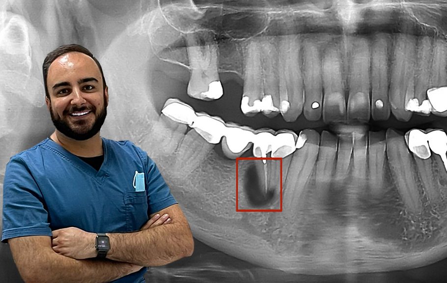 Gagrena zuba, dr Ivan Stanić