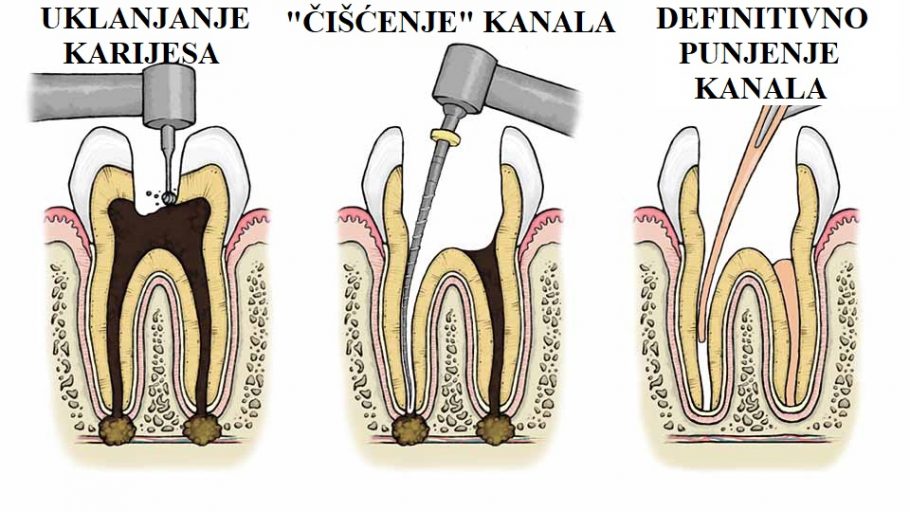 Gangrena zuba, lečenje