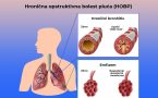 hronična opstruktivna bolest pluća-hobp-lečenje