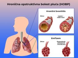 hronična opstruktivna bolest pluća-hobp-lečenje