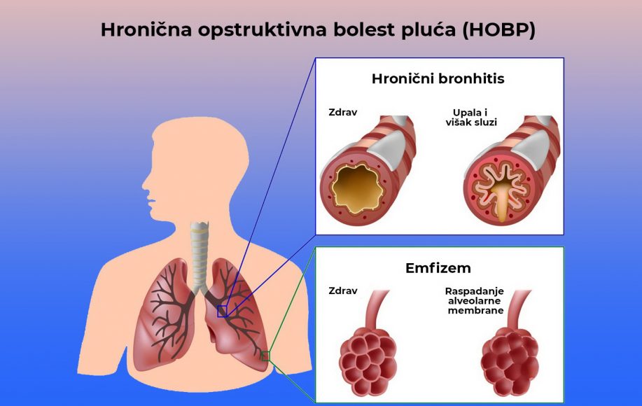 hronična opstruktivna bolest pluća-hobp-lečenje