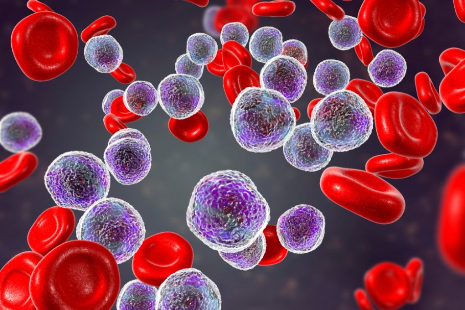 leukemija- limfomi- rak krvih ćelija