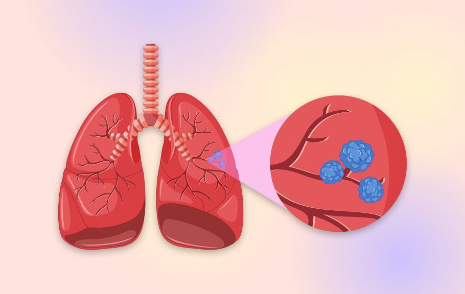 rak pluća-nepušači-uzroci pojave raka kod nepušača
