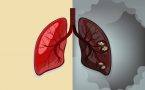 rak pluća -ko su rizične osobe