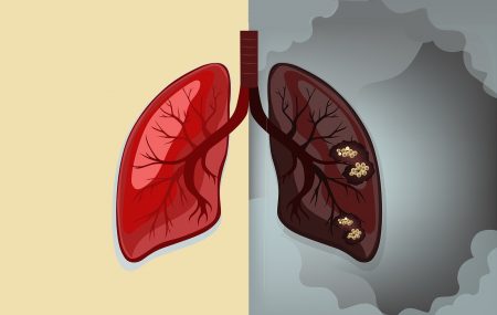 rak pluća -ko su rizične osobe