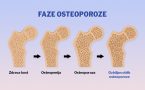 osteoporoza-osteopenija- razgradnja kostiju