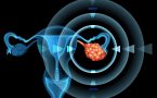 rak karcinom jajnika- stadijum raka-faze lečenja