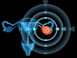rak karcinom jajnika- stadijum raka-faze lečenja