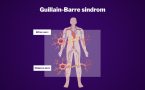Guillain-Barre sindrom- covid 19-okidač