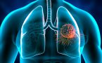 rak pluća- metastaze na mozgu