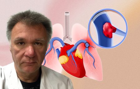 Prof.dr Slobodan Obradović, tromboembolijska bolest pluća