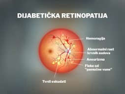 dijabetička retinopatija- slepilo- vid